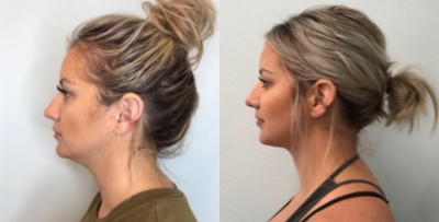 Juvederm before and after photo
