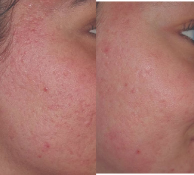 ProFractional Laser before and after photo