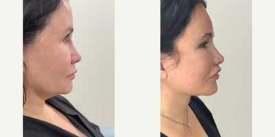 Brow Lift before and after photo