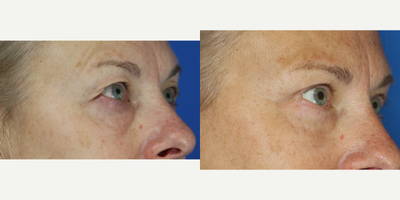 Eyelid Surgery before and after photo