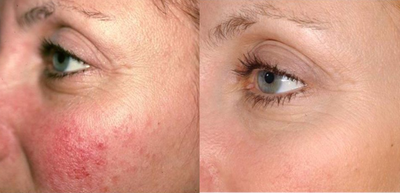 Laser Genesis before and after photo