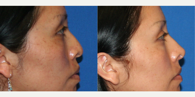 Nonsurgical Nose Job before and after photo