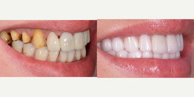 Botox for Gummy Smile before and after photo