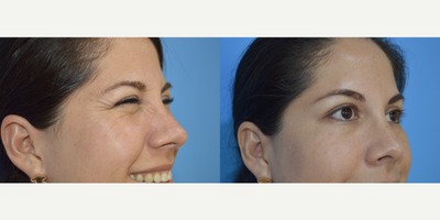 Botox before and after photo