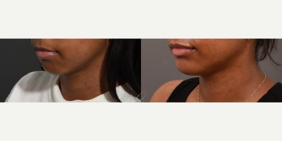Chin Implant before and after photo