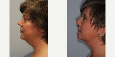 Chin Liposuction before and after photo