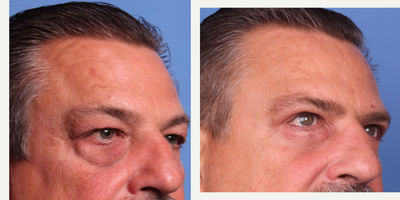 Eyelid Surgery before and after photo
