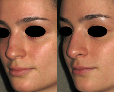 Nonsurgical Nose Job before and after photo