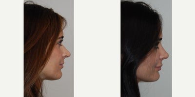 Silikon 1000 before and after photo