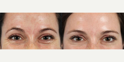 Botox before and after photo