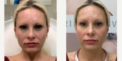 Dermal Fillers before and after photo