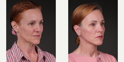 Facial Fat Transfer before and after photo