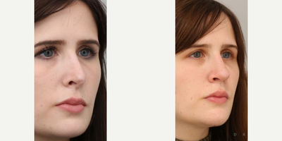 Revision Rhinoplasty before and after photo