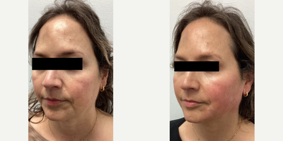Cheek Fillers before and after photo