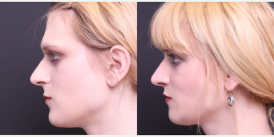 Jaw Reduction before and after photo