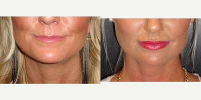 Lip Fillers before and after photo