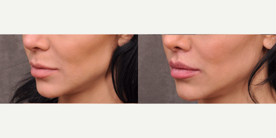 Lip Lift before and after photo