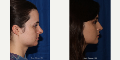 Rhinoplasty before and after photo