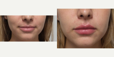 Voluma before and after photo