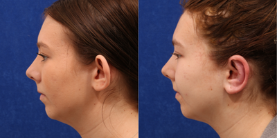 Ear Surgery before and after photo