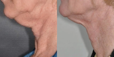 Exilis before and after photo