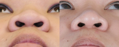 Asian Rhinoplasty before and after photo