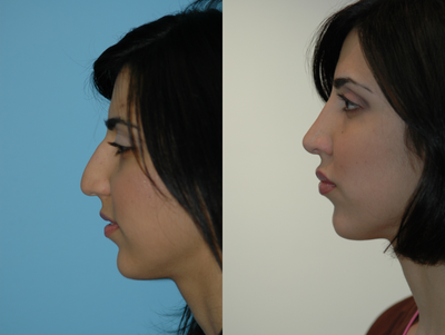 Juvederm before and after photo