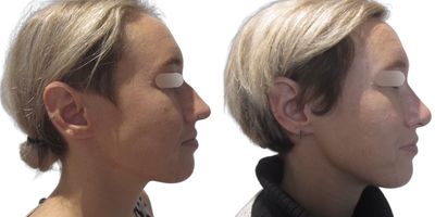 Septoplasty before and after photo