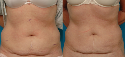 CoolSculpting before and after photo
