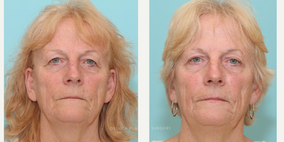 Eyelid Surgery before and after photo
