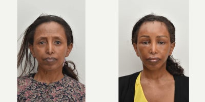 Facelift before and after photo