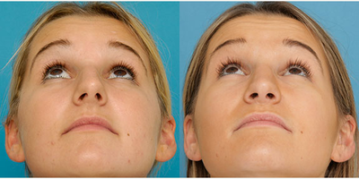 Rhinoplasty before and after photo