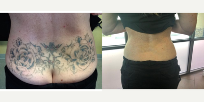 Tattoo Removal before and after photo