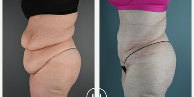 Tummy Tuck before and after photo