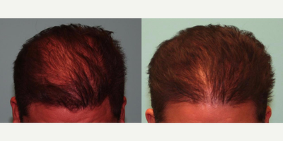 FUE Hair Transplant before and after photo