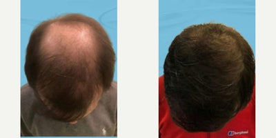 FUE Hair Transplant before and after photo