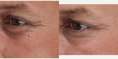 Belotero before and after photo
