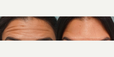 Botox before and after photo