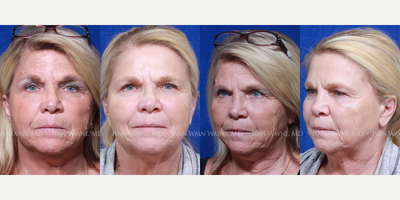 CO2 Laser before and after photo