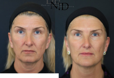 Dermal Fillers before and after photo