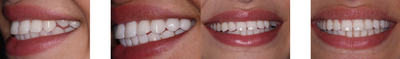 Porcelain Veneers before and after photo