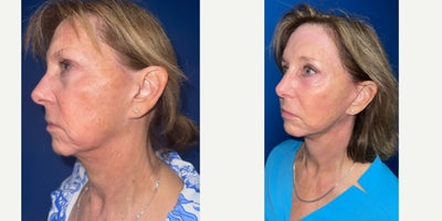 before and after image