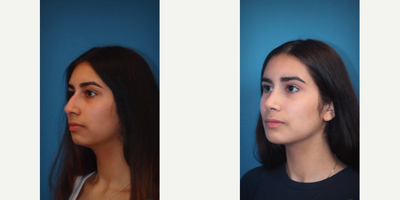 Chin Implant before and after photo