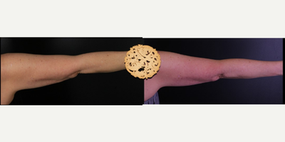 CoolSculpting before and after photo