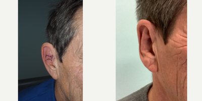 Earfold before and after photo