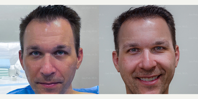 FUE Hair Transplant before and after photo