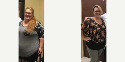 Gastric Sleeve Surgery before and after photo