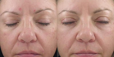 Glycolic Peel before and after photo