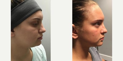 Kybella before and after photo