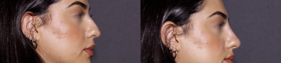 Nonsurgical Nose Job before and after photo